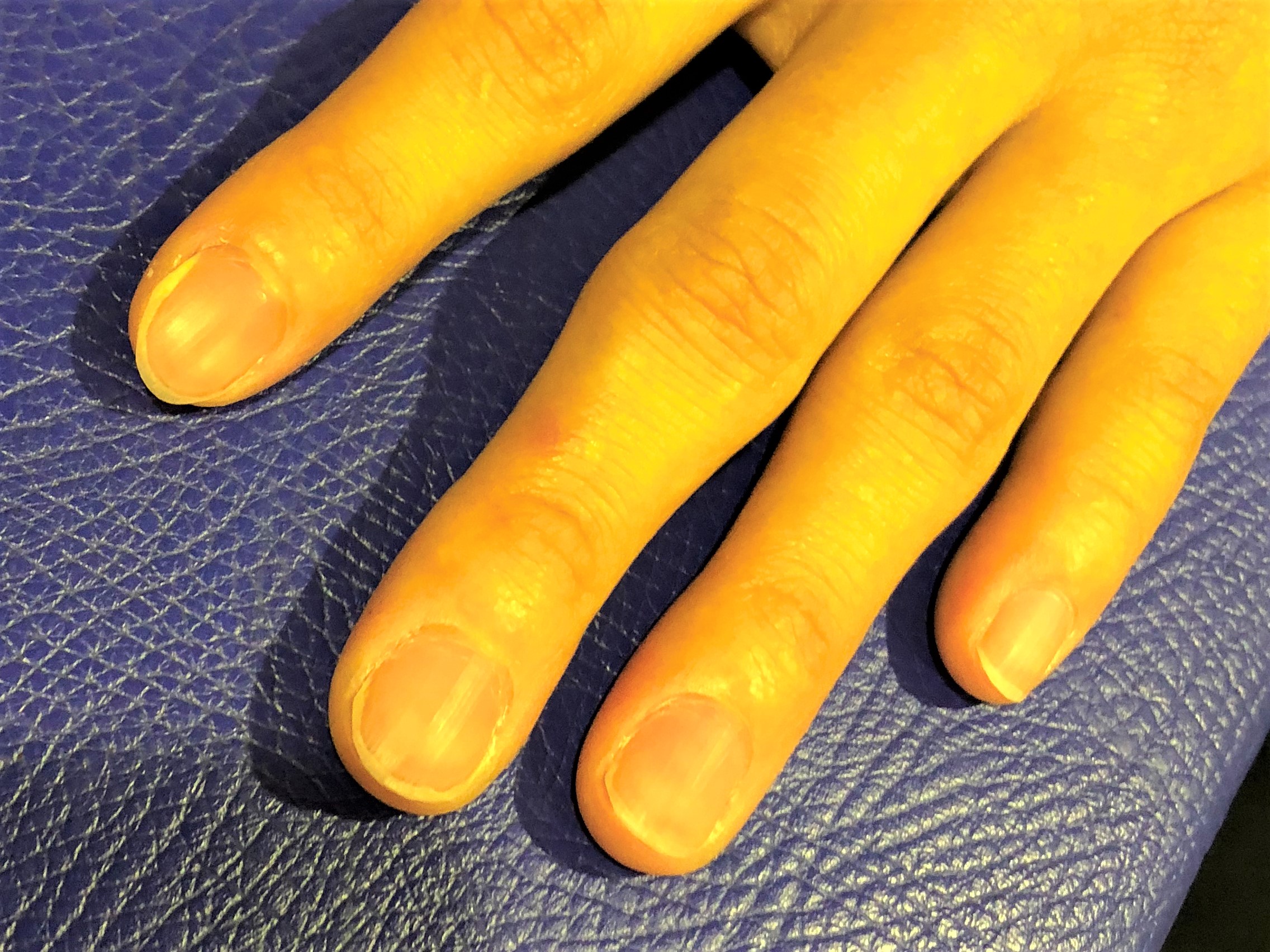 爪矯正 爪育成専門サロンnail Clinique 名古屋 岡山 深爪 噛み爪 巻き爪