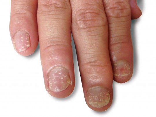 爪矯正 爪育成専門サロンnail Clinique 名古屋 岡山 深爪 噛み爪 巻き爪