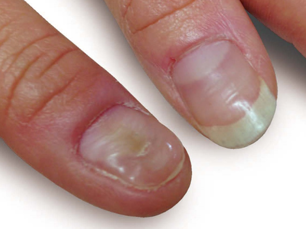 爪の横溝が発生 爪矯正 爪育成専門サロンnail Clinique ネイルクリニーク 名古屋 岡山 深爪 噛み爪 巻き爪