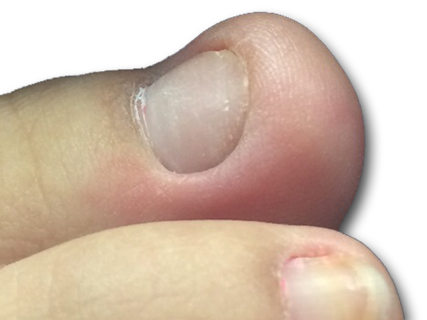 足の自爪ケア 爪専門店nailclinique 東京 福岡 名古屋 岡山 自爪育成 深爪矯正