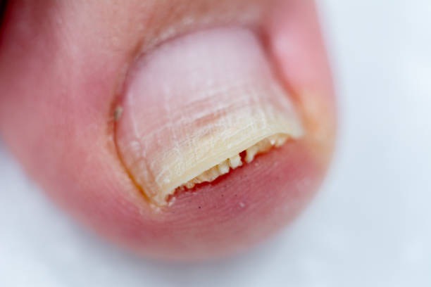 爪甲溶解症を取り除くにはどうすればよいですか?